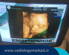 کاربردهای سونوگرافی در بارداری