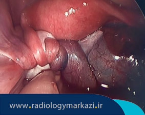 تورشن یا پیچ خوردگی تخمدان چیست؟