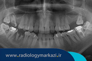 همه چیز در مورد پانورکس و سفالومتری دیجیتال