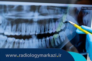 غربالگری با رادیوگرافی دندان ها در چه مواقعی صورت می گیرد؟