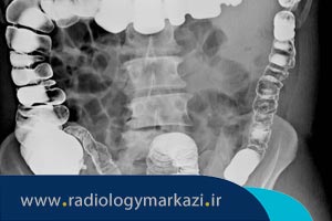 موارد استفاده از رادیوگرافی دستگاه گوارش تحتانی چیست؟
