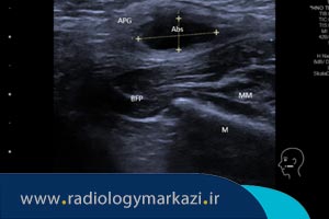 بررسی غدد بزاقی دهان با سونوگرافی به چه دلیل انجام میشود؟