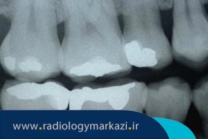 رادیوگرافی بایت وینگ (BW) دندان چیست؟