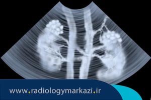 سونوگرافی کلیه برای تشخیص علت خون در ادرار