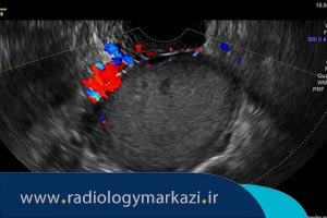 بهترین زمان سونوگرافی برای تشخیص اندومتریوز