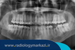 تشخیص پوسیدگی دندان از روی عکس رادیولوژی