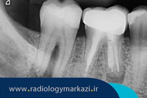تشخیص عفونت ریشه دندان با رادیوگرافی