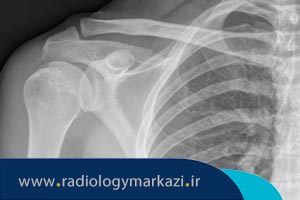 تشخیص شکستگی یا دررفتگی استخوان شانه با رادیوگرافی