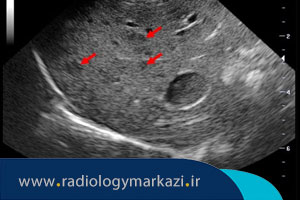 تفسیر نتایج سونوگرافی کبد