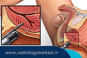 کاربرد سونوگرافی ترانس رکتال