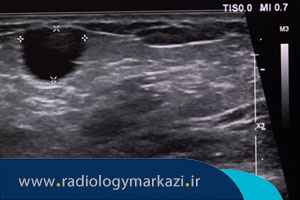 امکان تشخیص سرطان پستان با سونوگرافی