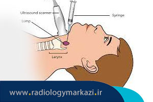 آسپیراسیون سوزنی (FNA) چیست و چه کاربردی دارد؟