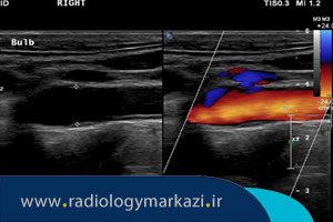 کاربرد سونوگرافی داپلر دوبلکس