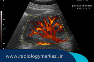 درباره سونوگرافی پاور داپلر چه می دانید؟