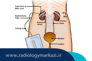 همه چیز درباره استنت حالب و نفروستومی