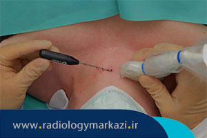 عمل rf تیروئید چیست و چگونه انجام میشود؟