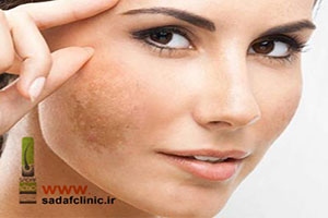 درمان لکه های پوستی