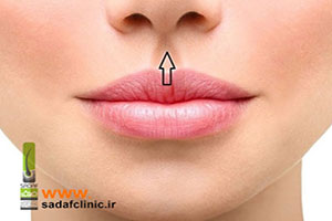 لیفت لب چیست و برای چه کسانی مناسب است؟