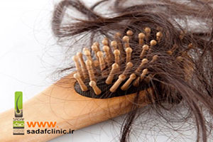 ریزش موی آندروژنیک یا از دست دادن ارثی مو
