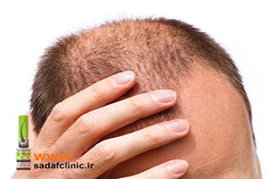 روش های کاشت مو و مزایا و معایب هر کدام از آنها