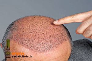 انواع روشهای کاشت مو و مزایا و معایب هر کدام از آنها