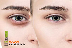 درمان گودی و سیاهی زیر چشم
