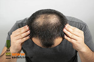 علائم ریزش مو با الگوی مردانه