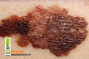 ملانوما، خطرناک ترین نوع سرطان پوست را بهتر بشناسید