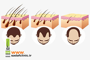 آشنایی با مدل های مختلف ریزش مو