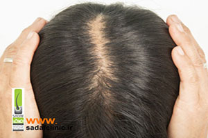 آیا ماینوکسیدیل در درمان ریزش مو مؤثر است؟