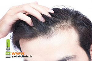 آیا ریزش مو قابل درمان است؟