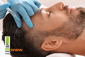 فیلر مو یا مزوتراپی، کدام یک در درمان ریزش مو مؤثرتر هستند؟