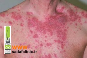بیماری پوستی پمفیگوس ولگاریس چه علل و علائمی دارد؟