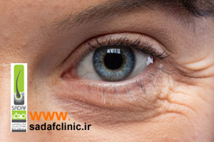 درمان خطوط پنجه کلاغی دور چشم با تزریق بوتاکس