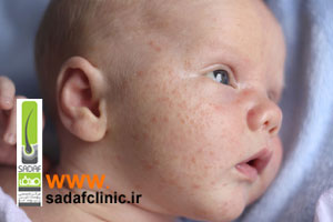شایعترین بیماریها و مشکلات پوستی در کودکان و نوزادان