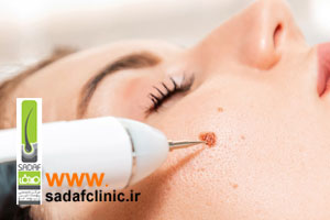 برداشتن خال با لیزر در اصفهان توسط متخصص پوست در کلینیک صدف