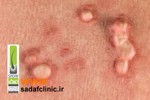درمان زگیل تناسلی با موثرترین روش در کلینیک صدف توسط پزشک متخصص