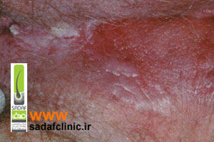 درمان صد در صد زگیل تناسلی زنان | واقعیت یا رویا