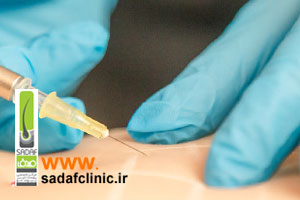 کربوکسی تراپی با جدیدترین دستگاه 2025 در کلینیک صدف اصفهان