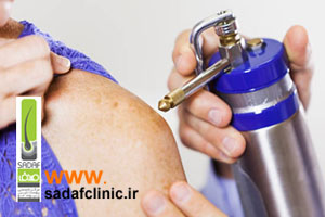 بعد از کرایوتراپی چه باید کرد؟ مراقبت های ضروری بعد از کرایوتراپی