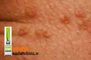 زگیل تناسلی مردانه چیست؟ + عکس زگیل تناسلی در مردان