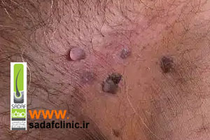 بهترین روش درمان زگیل تناسلی مردانه چیست؟