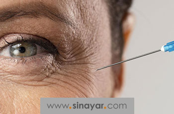 درمان خطوط پنجه کلاغی دور چشم با تزریق بوتاکس