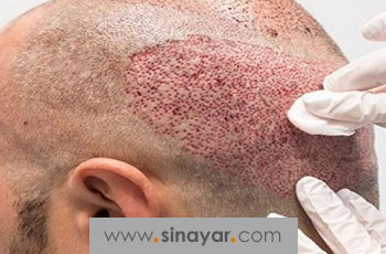 موارد منع کاشت مو؛ کاشت مو برای چه کسانی مناسب نیست؟