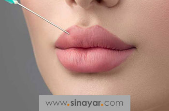 مراقبت های بعد از تزریق ژل لب؛ بایدها و نبایدهای ضروری