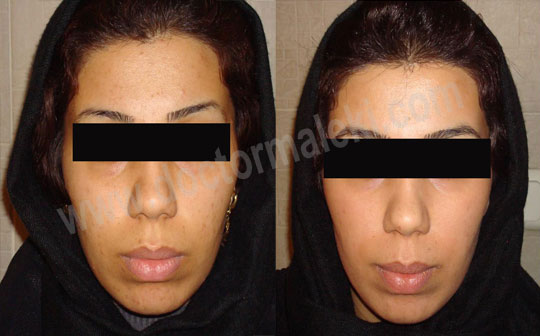 روشن کردن و کاهش جوش و جای جوش