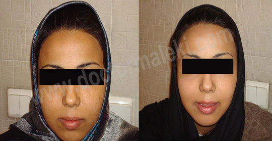 روشن کردن و کاهش کک و مک