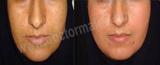 کاهش کک ومک وتیرگی پوست پس از یکبار میکرودرمابرژن