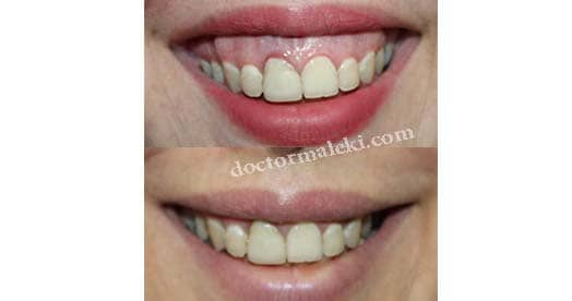 اصلاح لبخند لثه ای