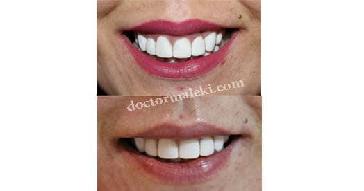 اصلاح لبخند لثه ای با تزریق بوتاکس